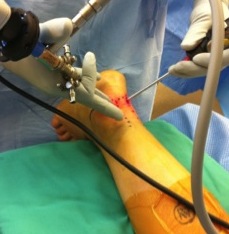 Posterior ankle arthroscopy